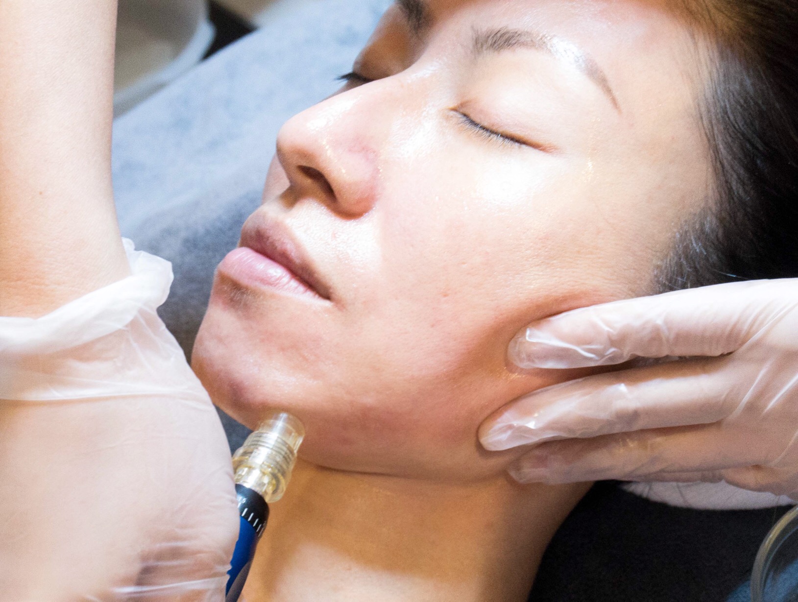 8 Things You Should Know About Micro-needling Therapy | Diva in Me