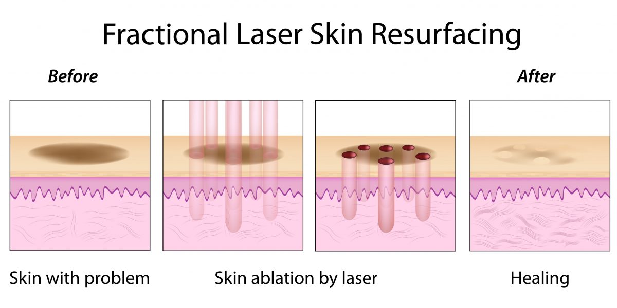 Fractional Co2 Laser Treatment