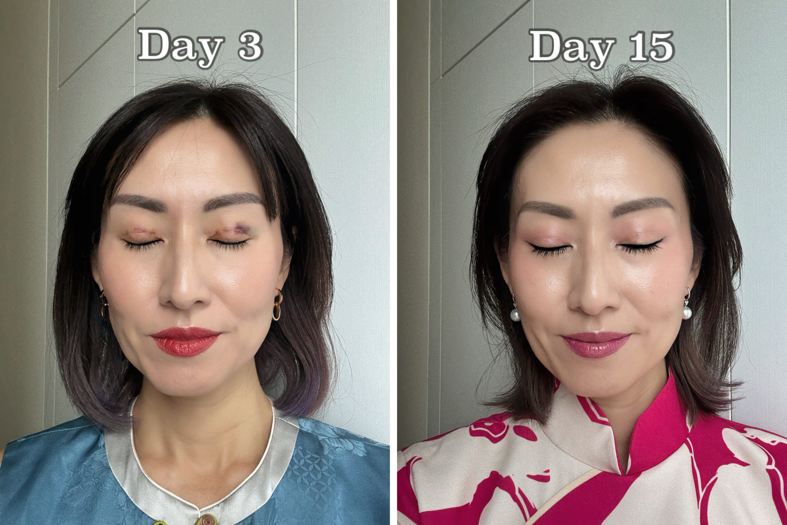 Day 15 After DST Procedure